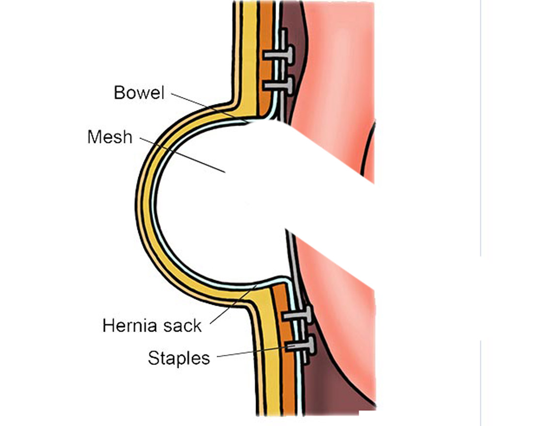  Open surgery Hernia
